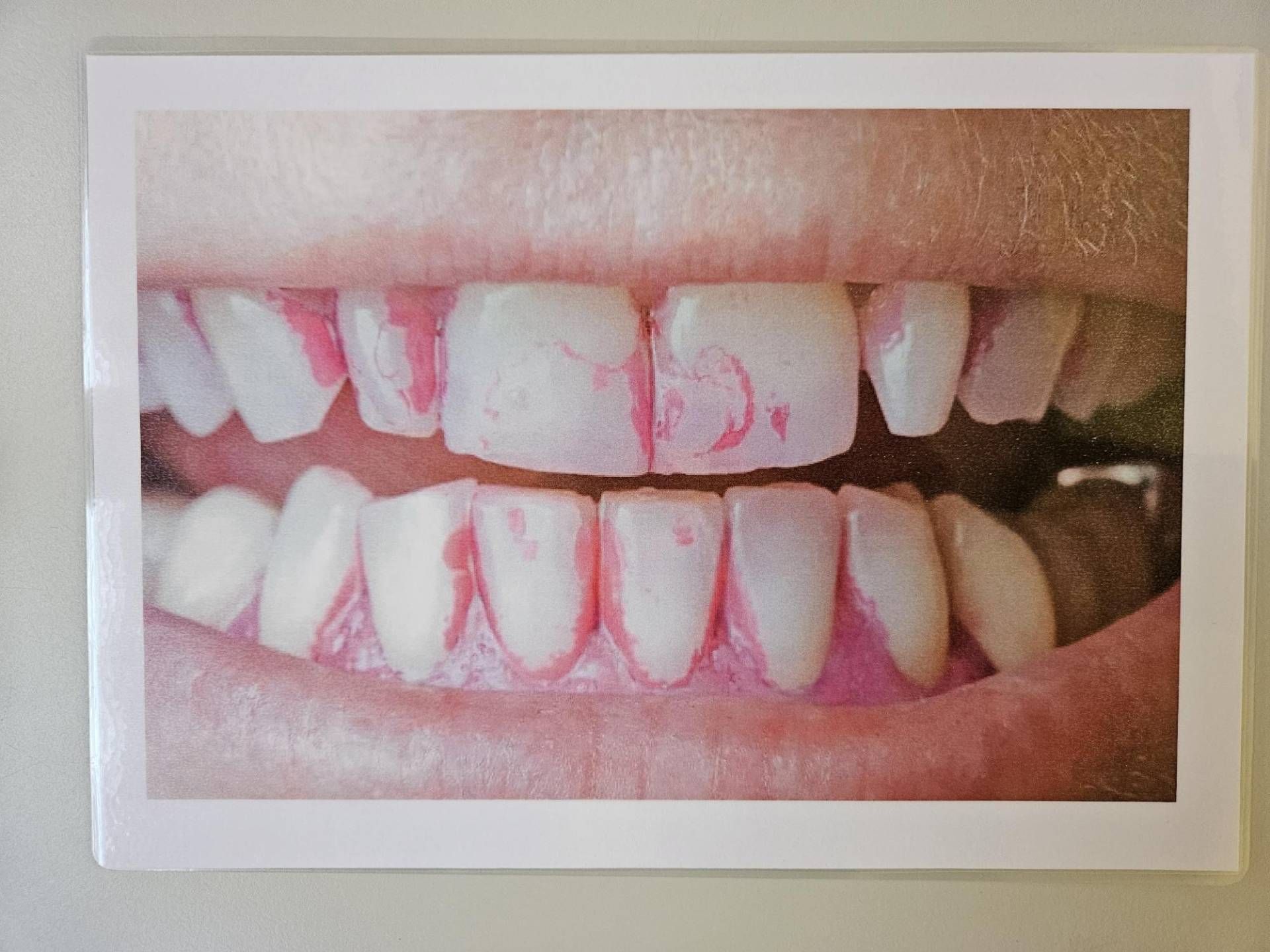 Schlecht geputzte Zähne